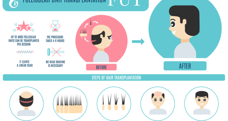 FUT Hair Transplant