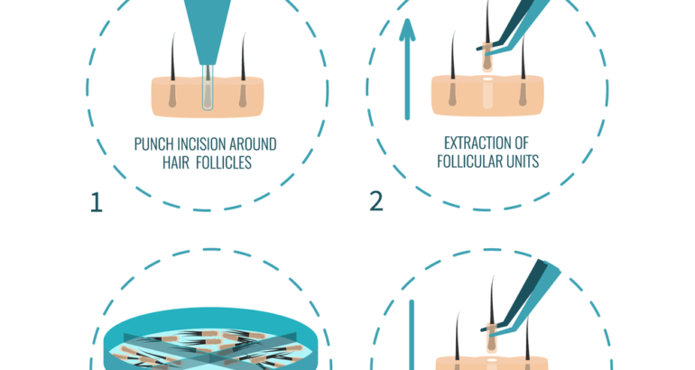 FUE Hair Transplant Islamabad