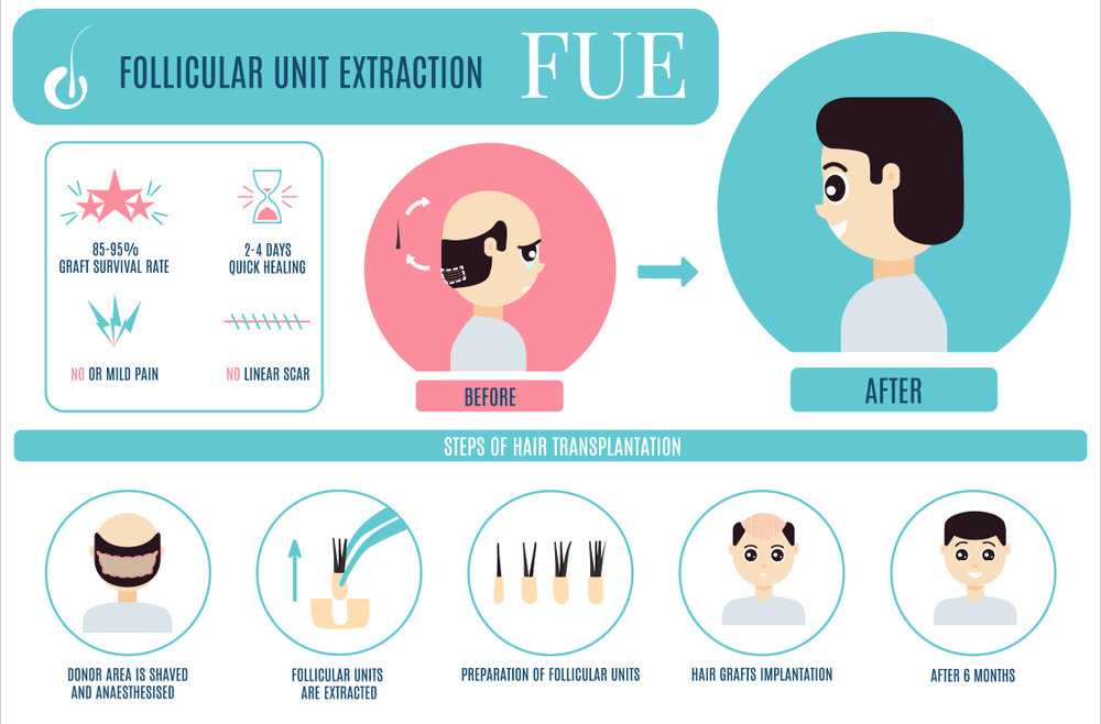 FUE Hair Transplant Cost In Pakistan