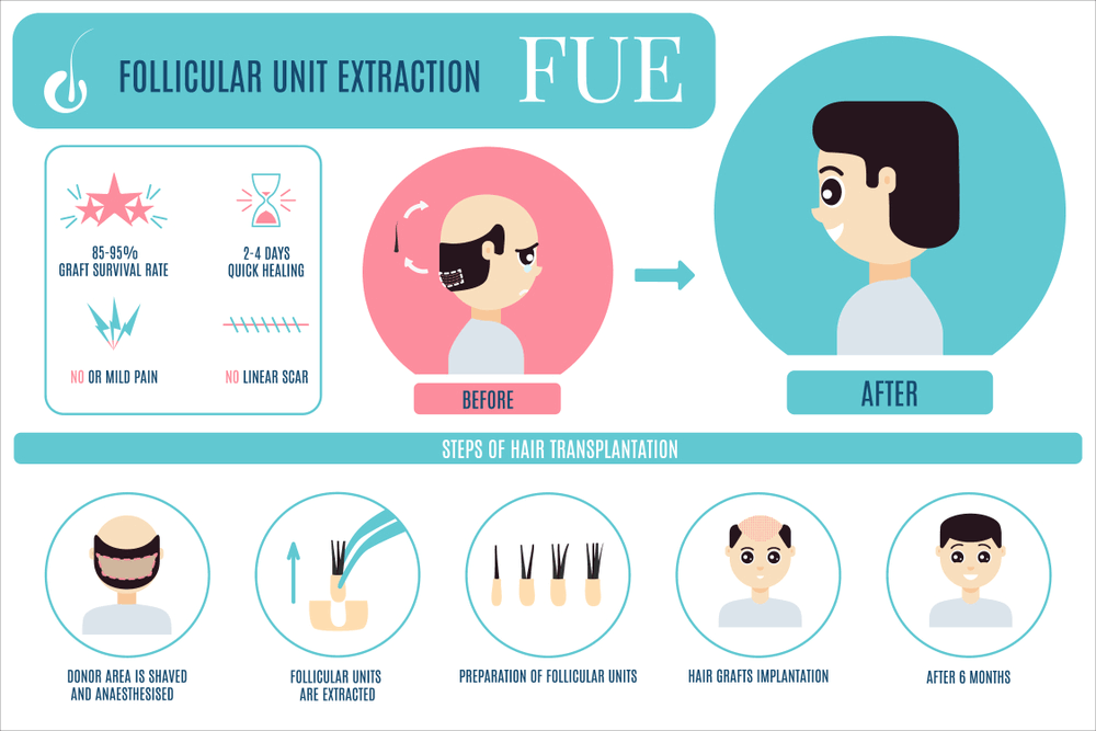 FUE Hair Transplant Cost In Pakistan