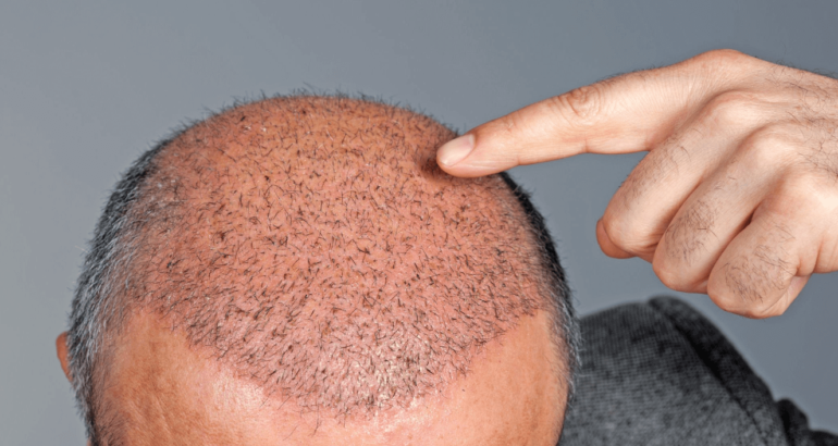 What is the Cause of Hair Loss in Males in Pakistan?